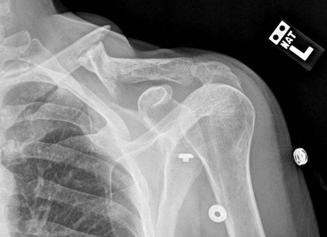 recovering from a collar bone injury