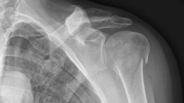 proximal humerus fracture cyclist