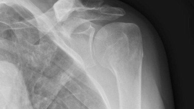 proximal humerus fracture cyclist