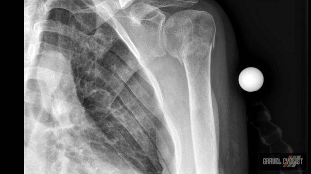 proximal humerus fracture cyclist